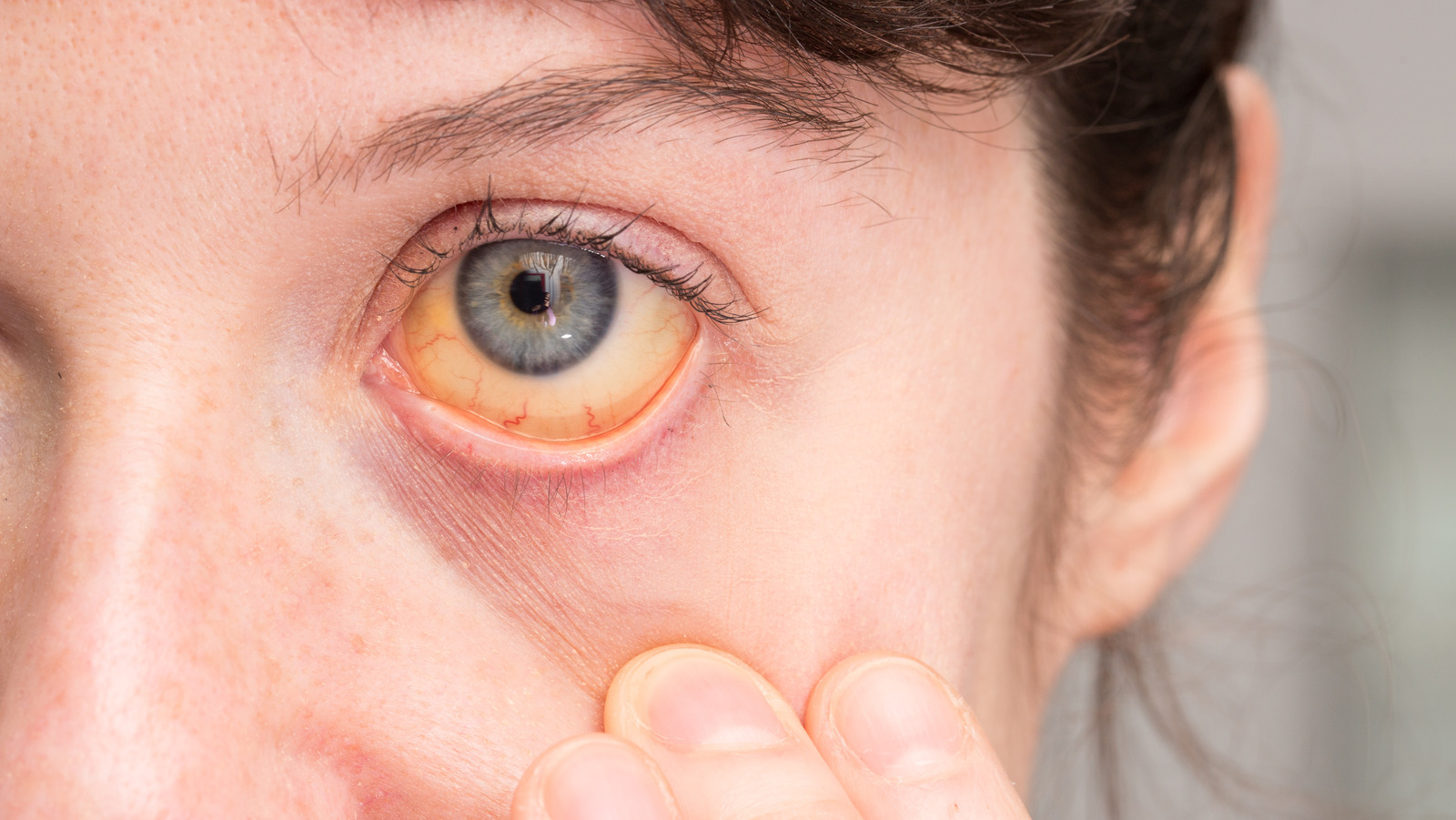 causes of jaundice eyes