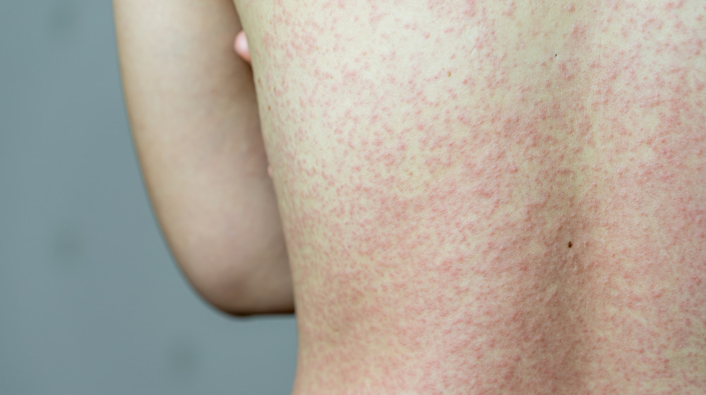 A breakout of hives on a woman's back