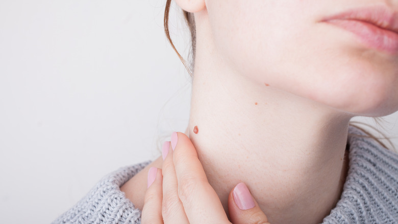 Mole on side of neck 