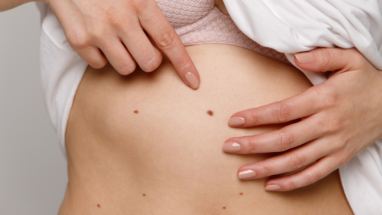 Woman pointing at a mole on her stomach