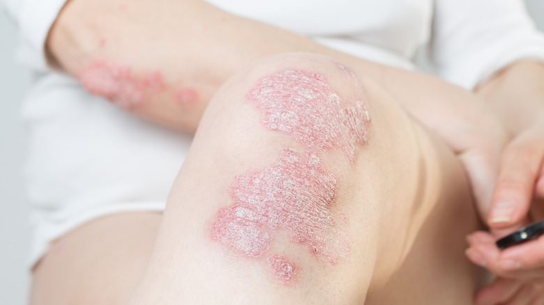 Woman with eczema, which can cause pubic itching