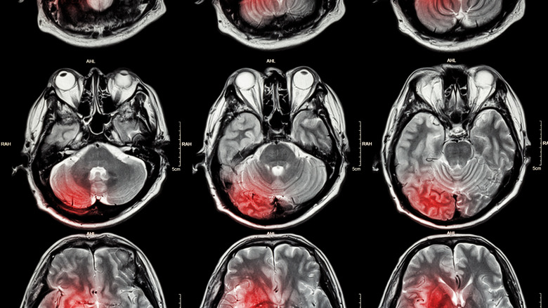 MRI images of a stroke