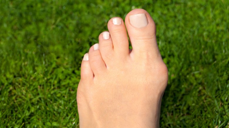 women's foot with a bunion