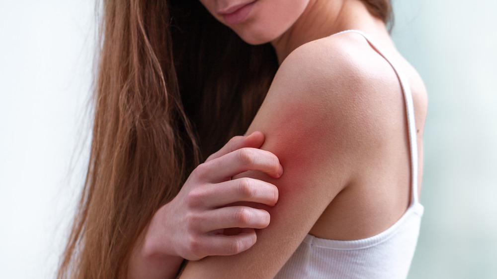 A woman with a sore and irritated arm