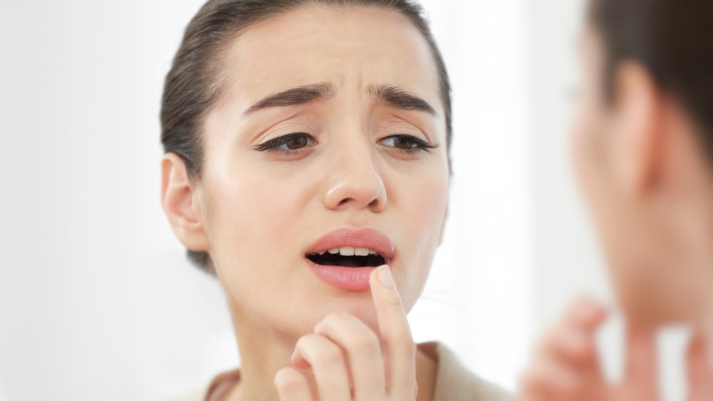 Woman with cold sore