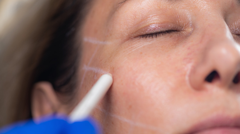 Woman being prepped for filler injections