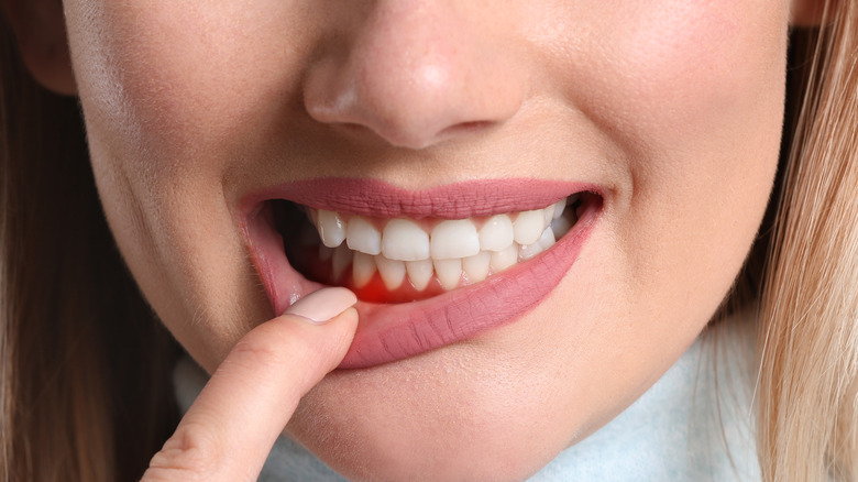 Woman pointing out her gum inflammation