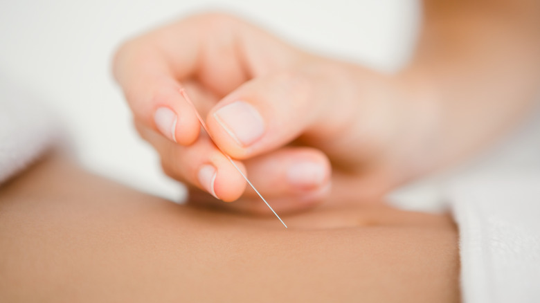 Woman performing acupuncture