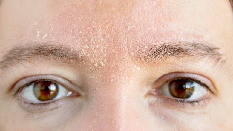 Woman's eyebrow rash
