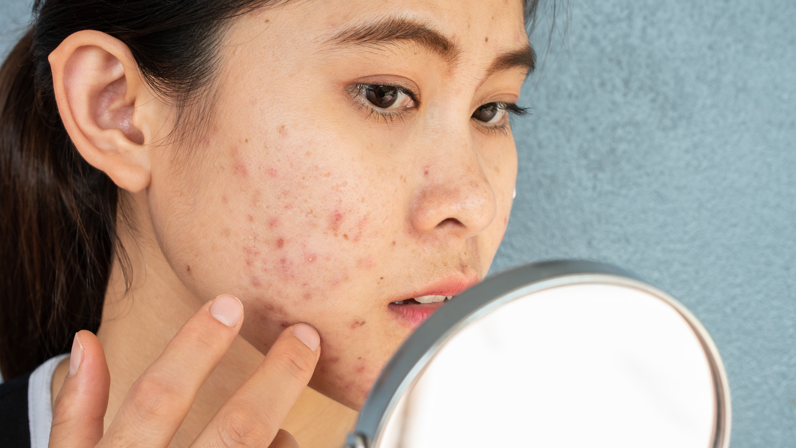 what-is-subcision-and-how-does-it-help-acne-scars