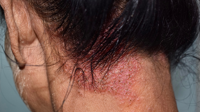 fungal infection on scalp