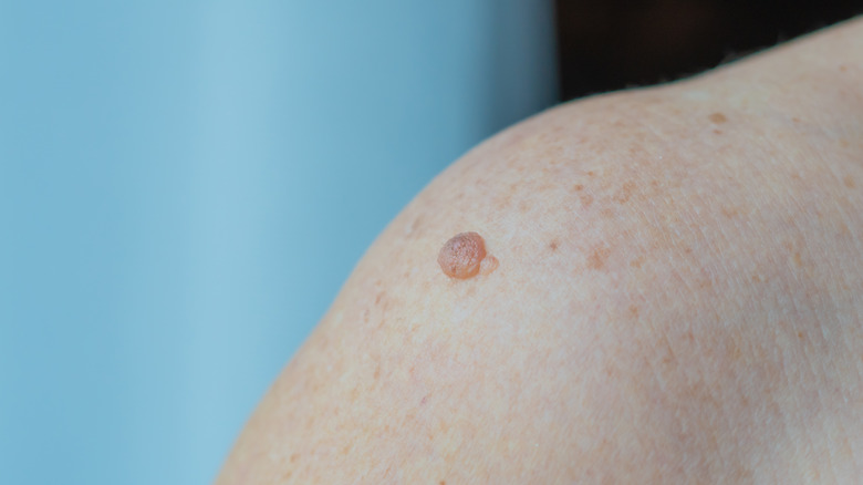 Shoulder moles are usually harmless