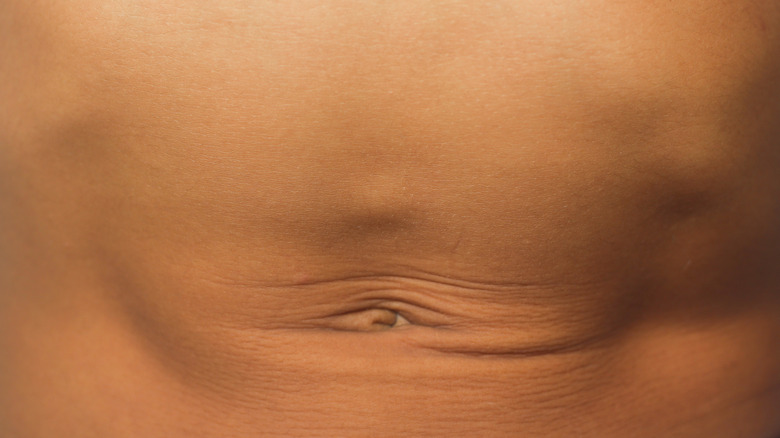 A person with an abdominal hernia