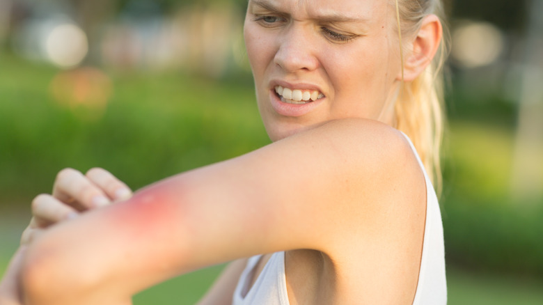 A woman inspecting a bug bite on her arm 