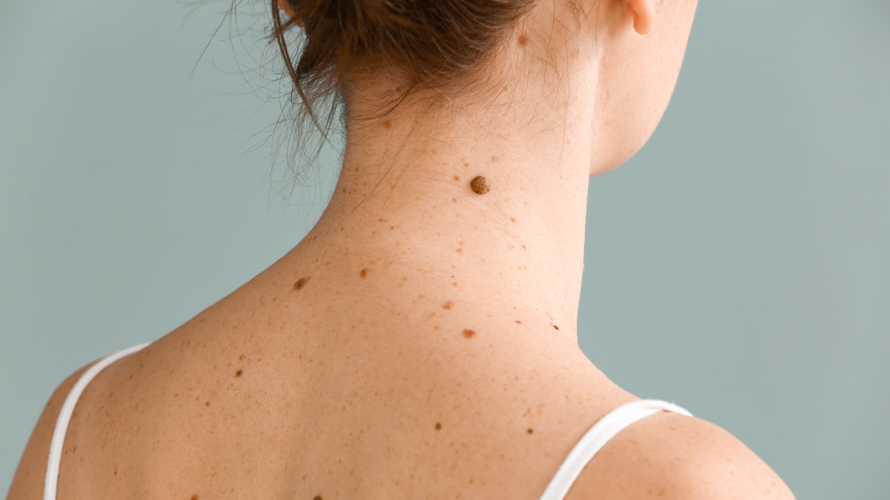 What It Really Means When You Have A Mole On Your Back