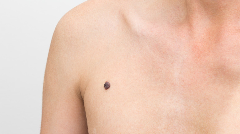 Close-up of a chest mole