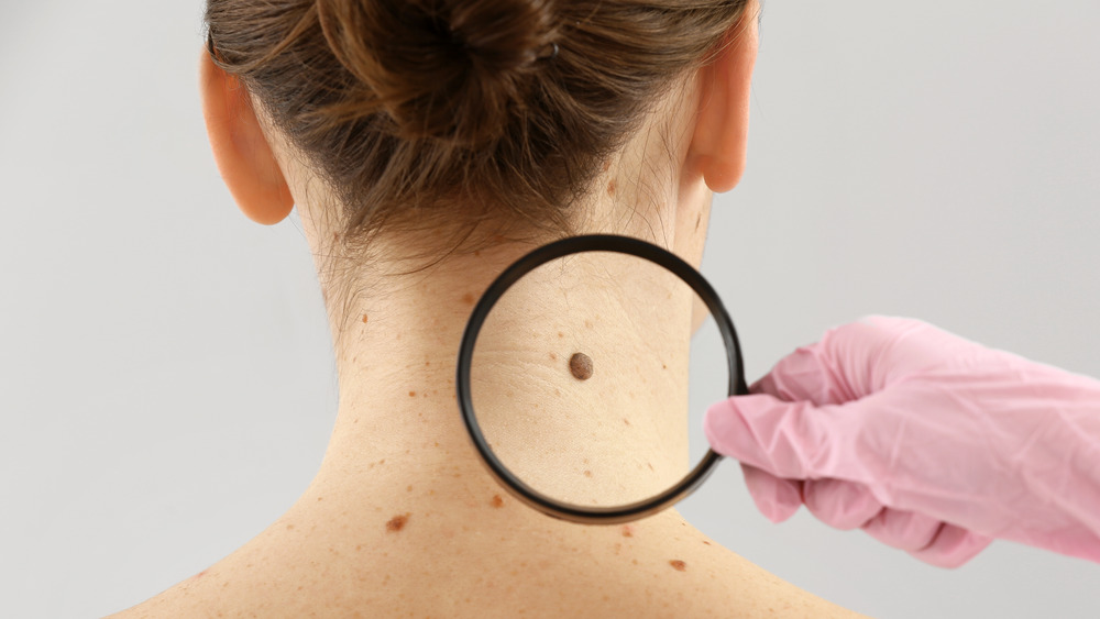 doctor examining mole on woman's neck