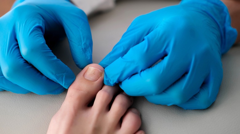 Doctor examining an Onycholysis patient