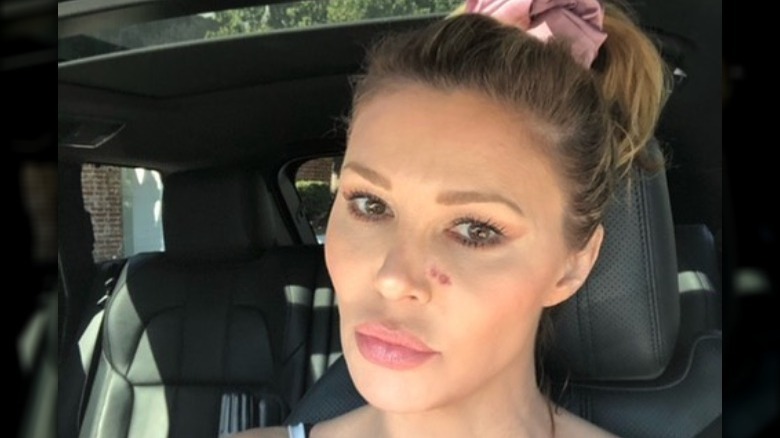 Brandi Glanville with psoriasis