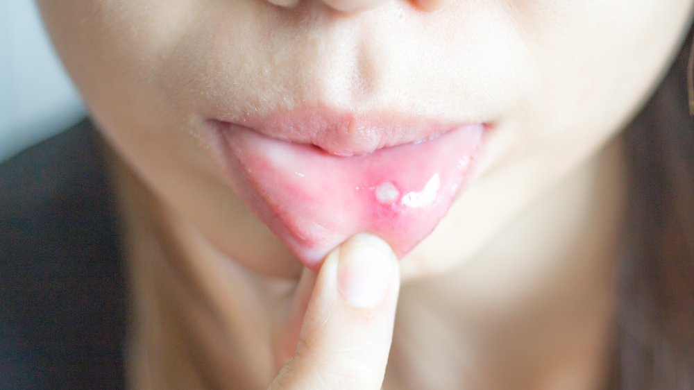 There Are Various Causes For Canker Sores 1585924237 