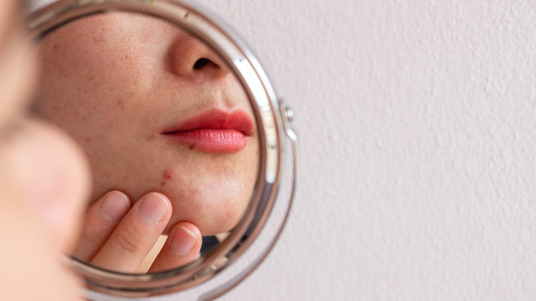 A woman looking at chin pimple in a mirror 