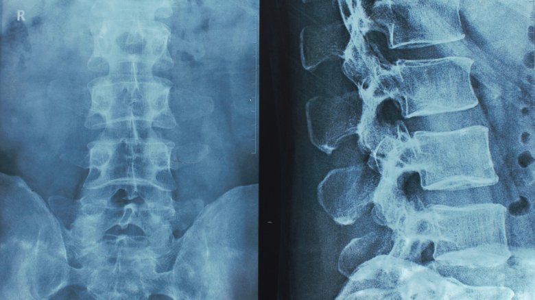 X-rays of the spine