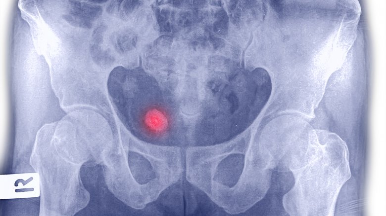 An ex-ray of a kidney stone (concept)