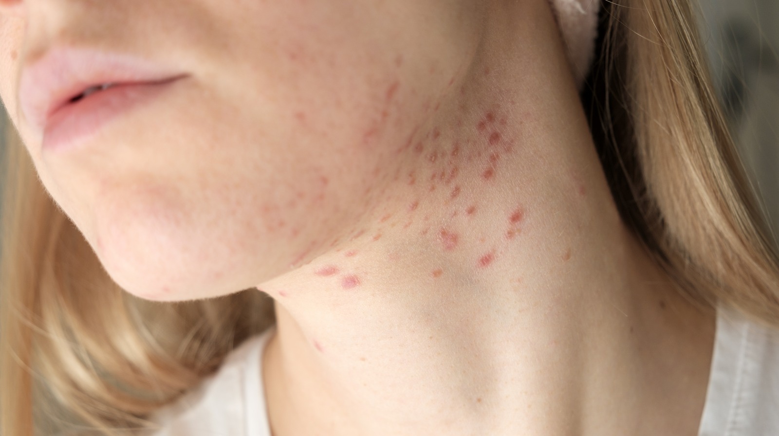 What Should You Do About Stubborn Acne On Your Neck 