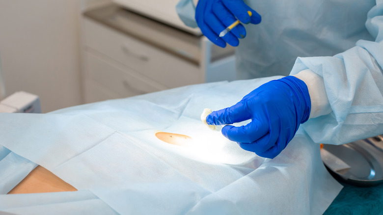 A doctor doing a skin biopsy