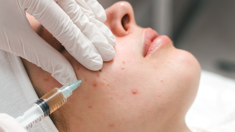 dermatological injection into acne scar