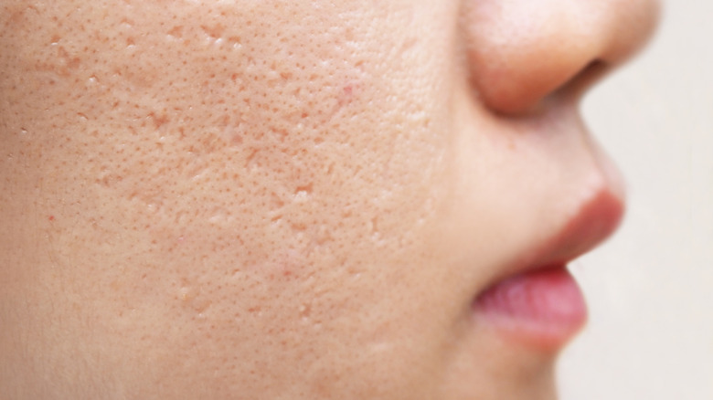 face dermatology acne scars
