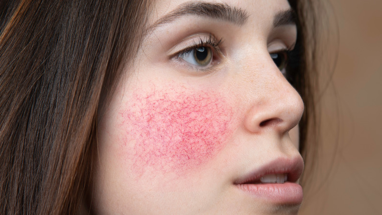 face rosacea redness