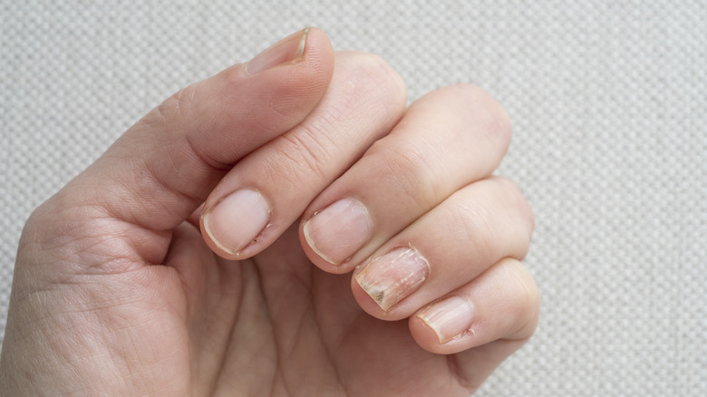 damaged nail 