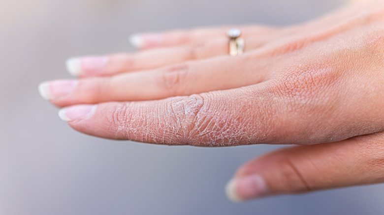 Hand with dry skin