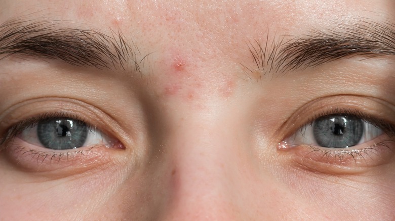 Woman with acne between eyebrows