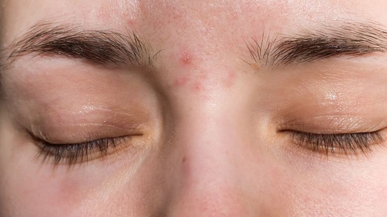 What s Causing Acne Between Your Eyebrows And How Do You Get Rid Of It 