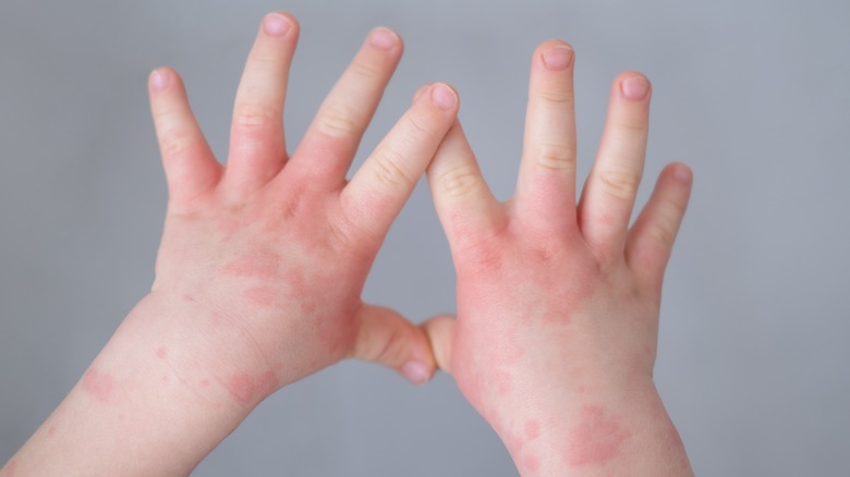 Whats The Difference Between Eczema And Psoriasis