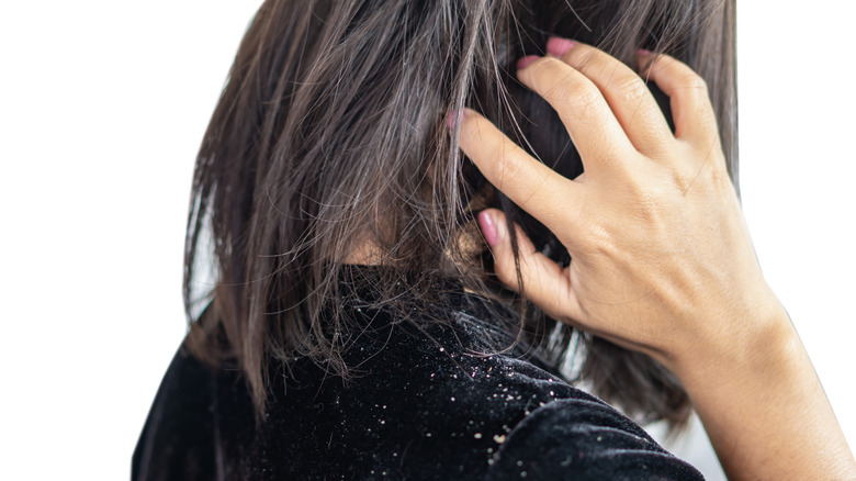 Woman with dry dandruff closeup