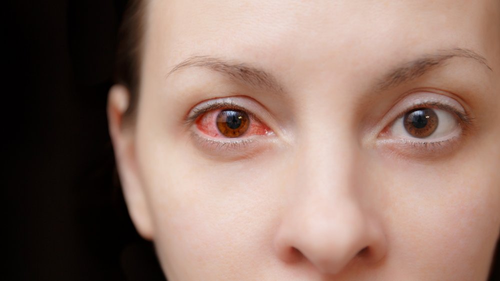 a woman with pink eye, a symptom of coronavirus