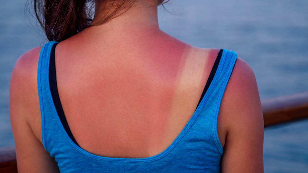 Woman with painful sunburn