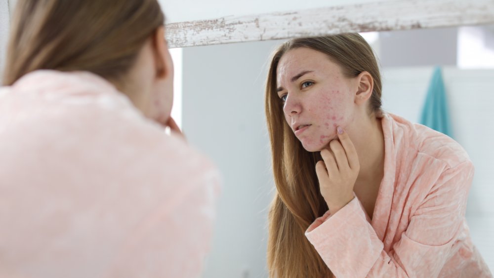 a woman with acne