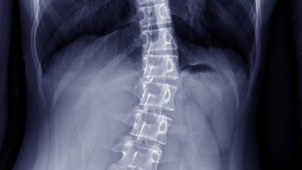 A x-ray of a woman's back