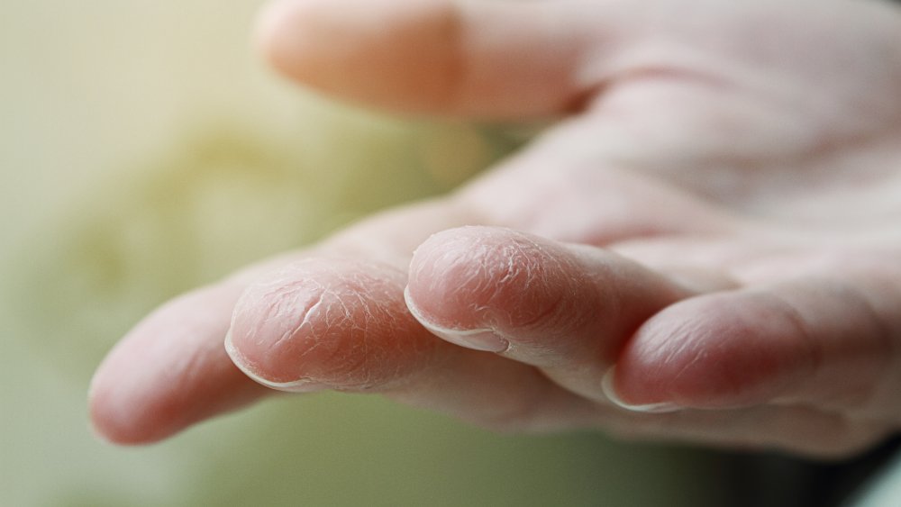 Close-up of a woman's hand with dry skin