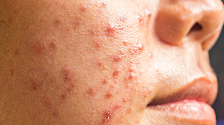 Woman with cystic acne on her cheeks 
