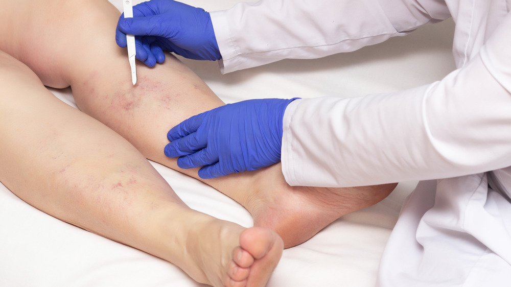 Doctor holding scalpel against legs of person with varicose veins