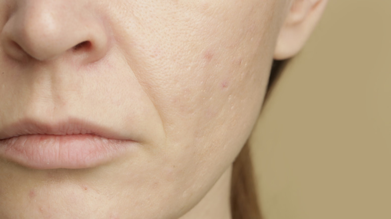 close up of a person's face showing nasolabial folds