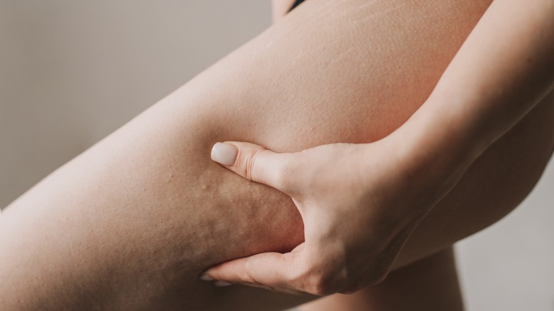 Why Are Women More Prone To Cellulite?