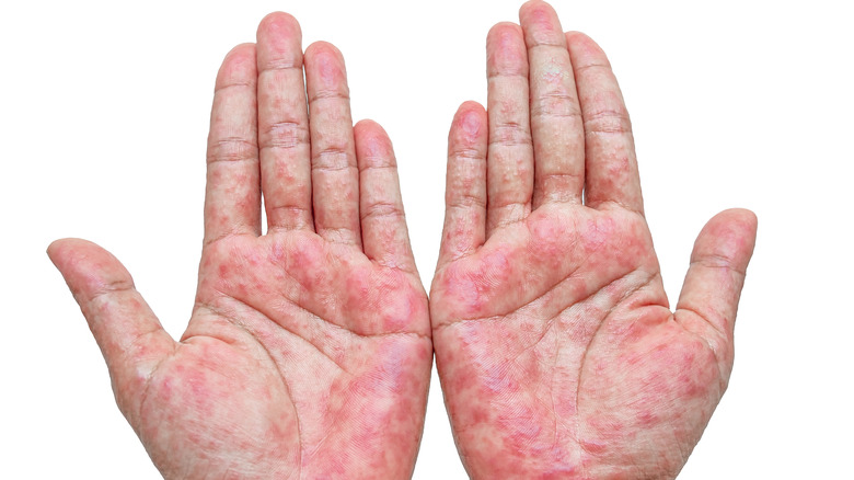 Contact dermatitis rash on the hands 