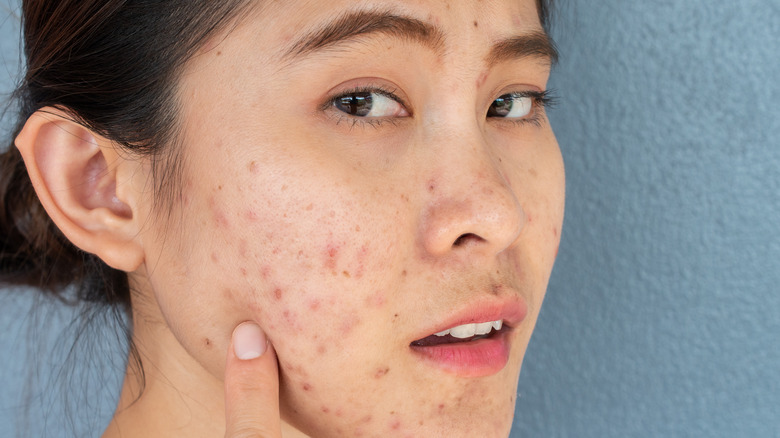 Women with acne on her cheeks 