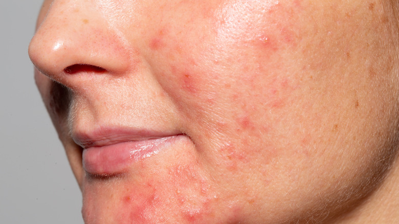 A closeup of a person with cystic acne